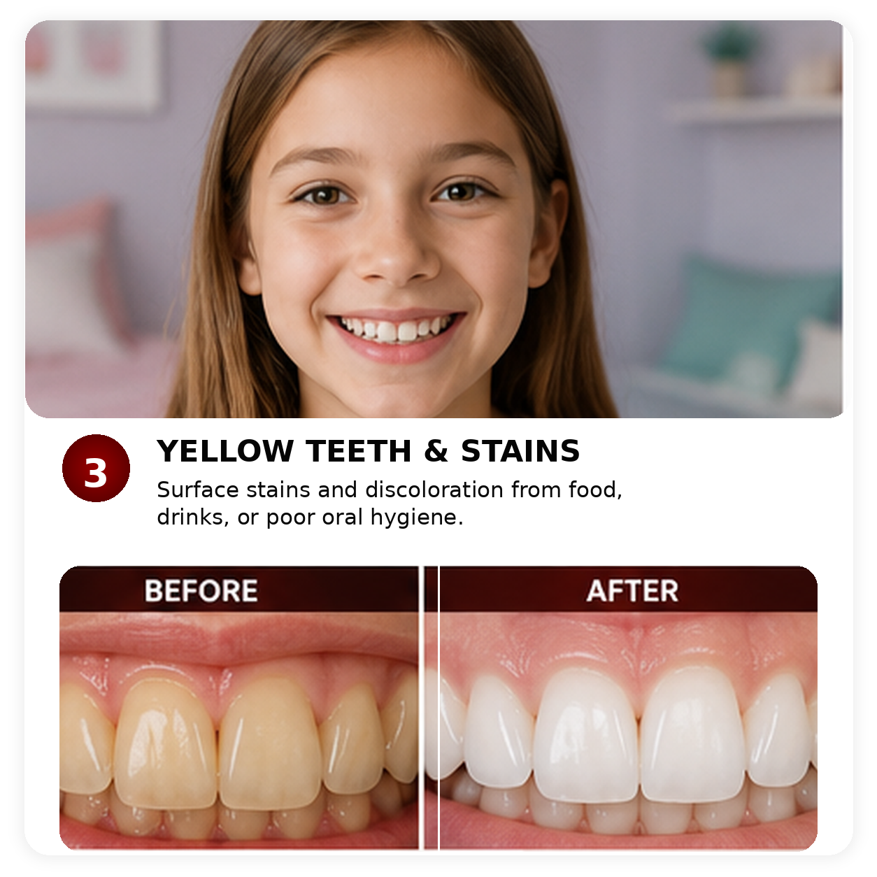 Illustrative before and after comparison of yellow surface stains on teeth