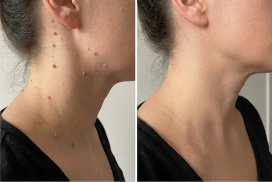 Customer neck before and after result