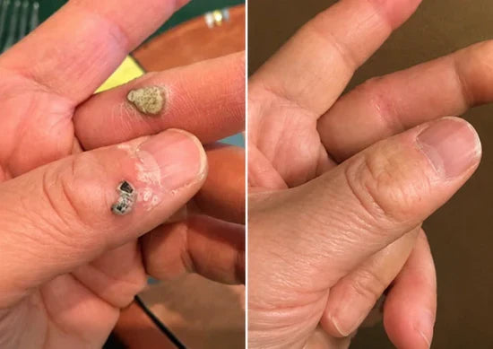 Customer finger before and after result