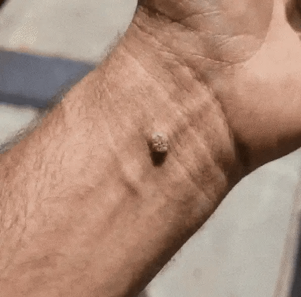 Close-up of a raised skin spot on the wrist
