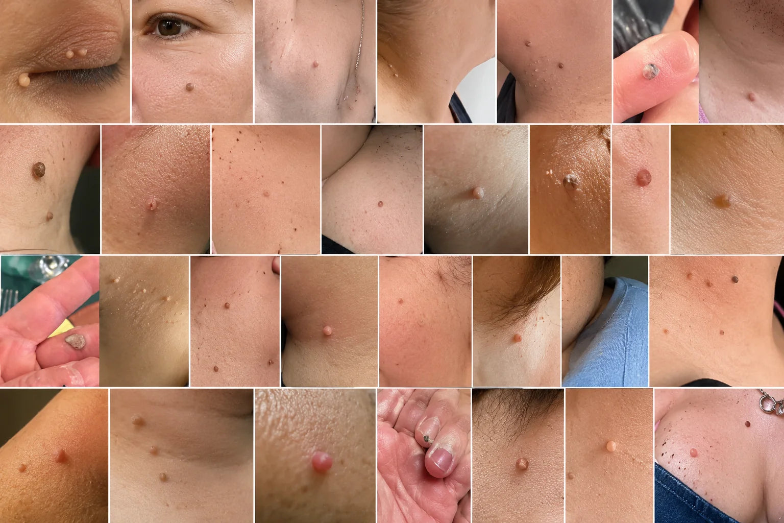 Examples of common raised skin bumps and skin tags